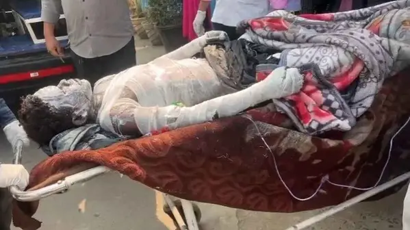 Cg Breaking | टायर रिसाइक्लिंग के दौरान बॉयलर फटा, 9 महीने के मासूम समेत 8 मजदूर झुलसे