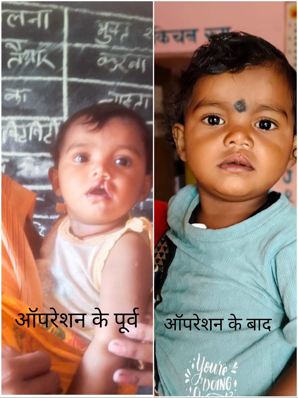 Chhattisgarh | चिरायु दल ने लौटाई मासूम रंजना की मुस्कान